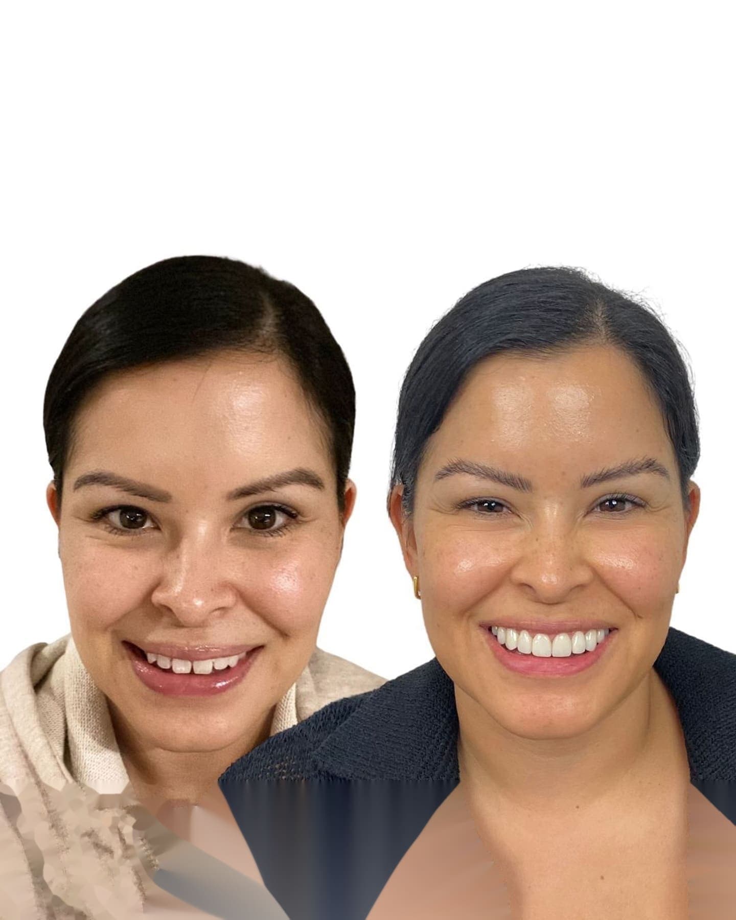 Blanqueamiento dental en casa: lo útil, lo flojo y lo peligroso