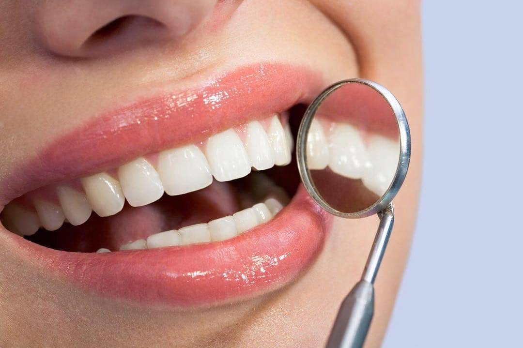 Resultado de blanqueamiento dental profesional para comparar precios en Madrid