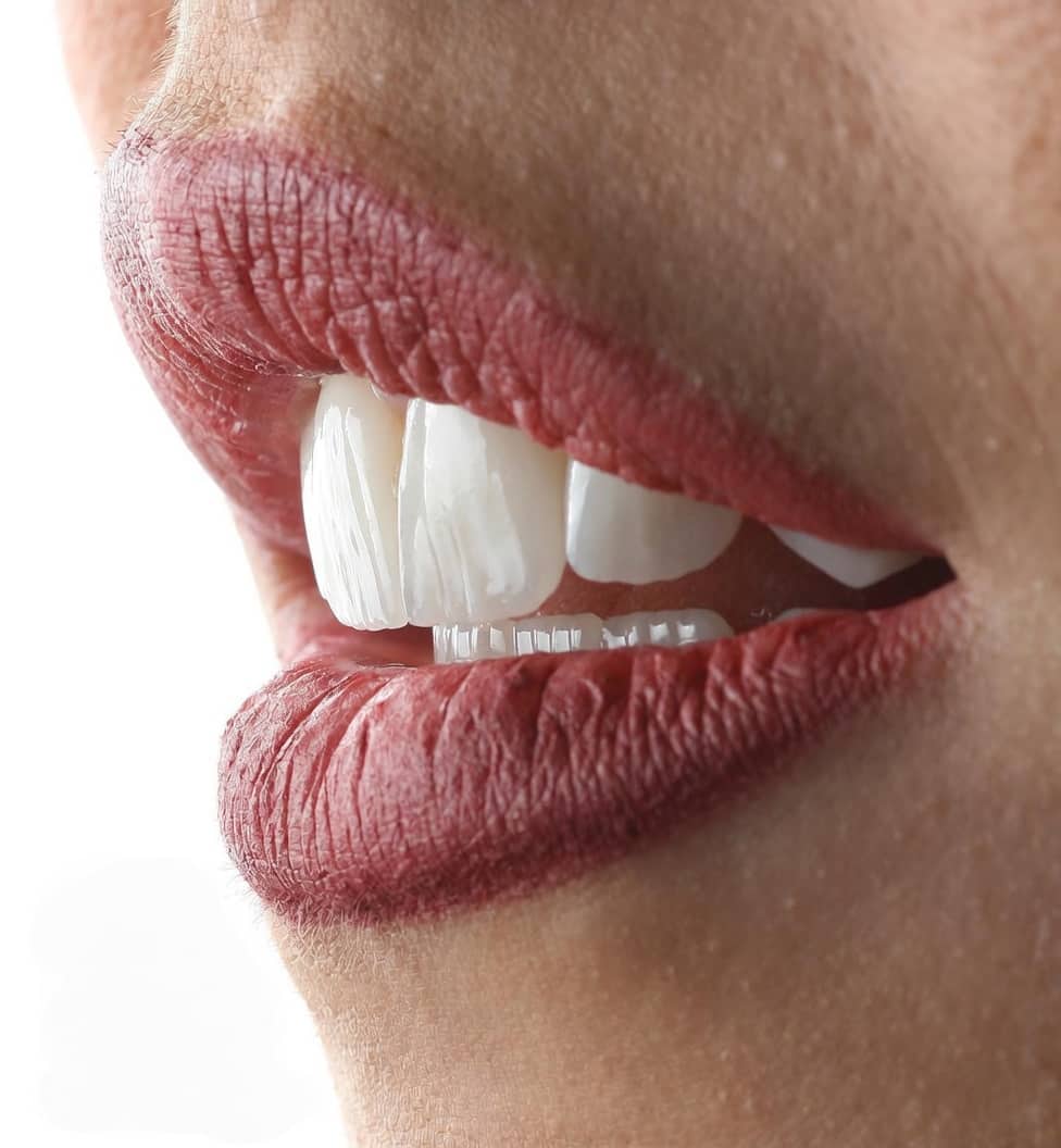 Sonrisa natural para valorar carillas dentales cerca de Fuencarral