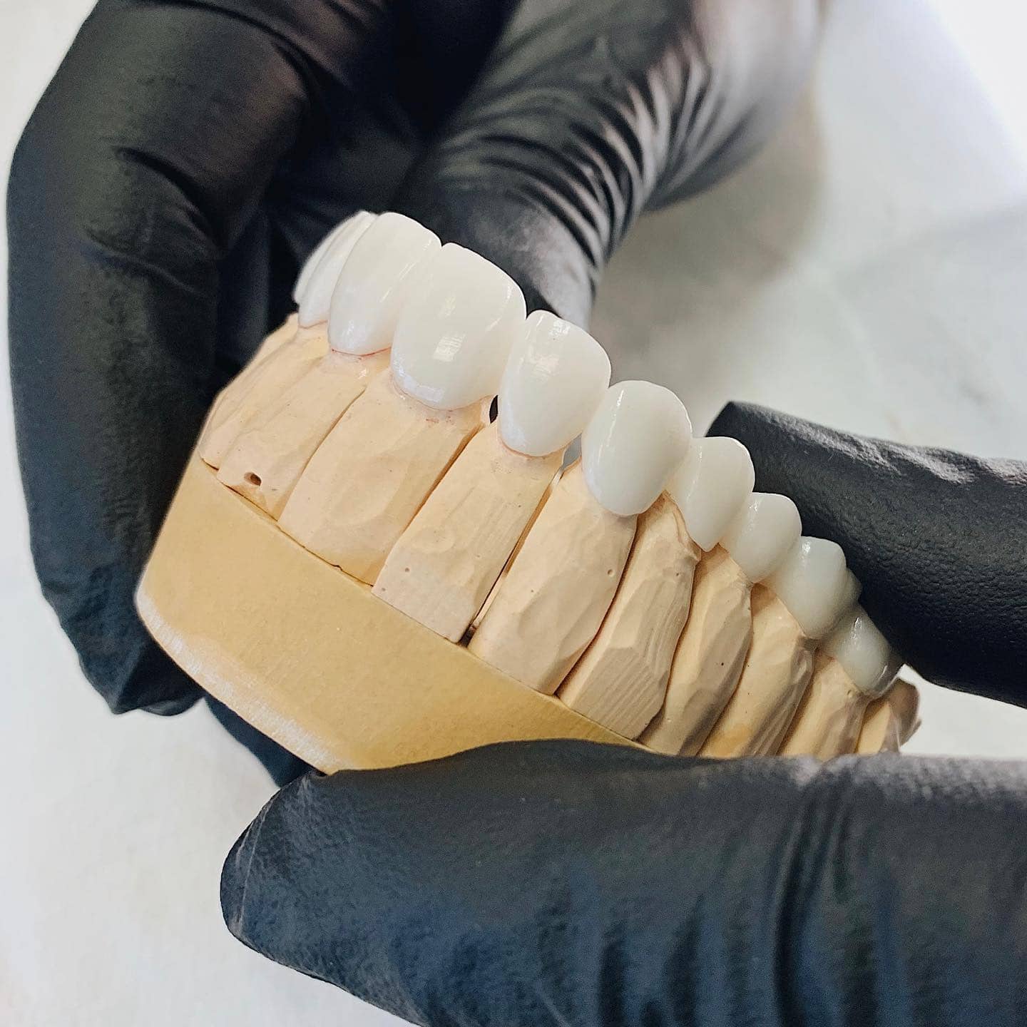 Sonrisa estética para comparar carillas de porcelana y zirconio
