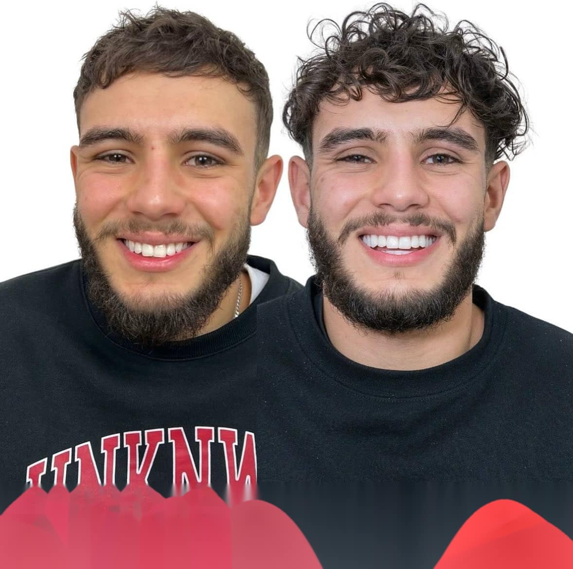 Diseño de sonrisa en Madrid: precio, fases y presupuesto