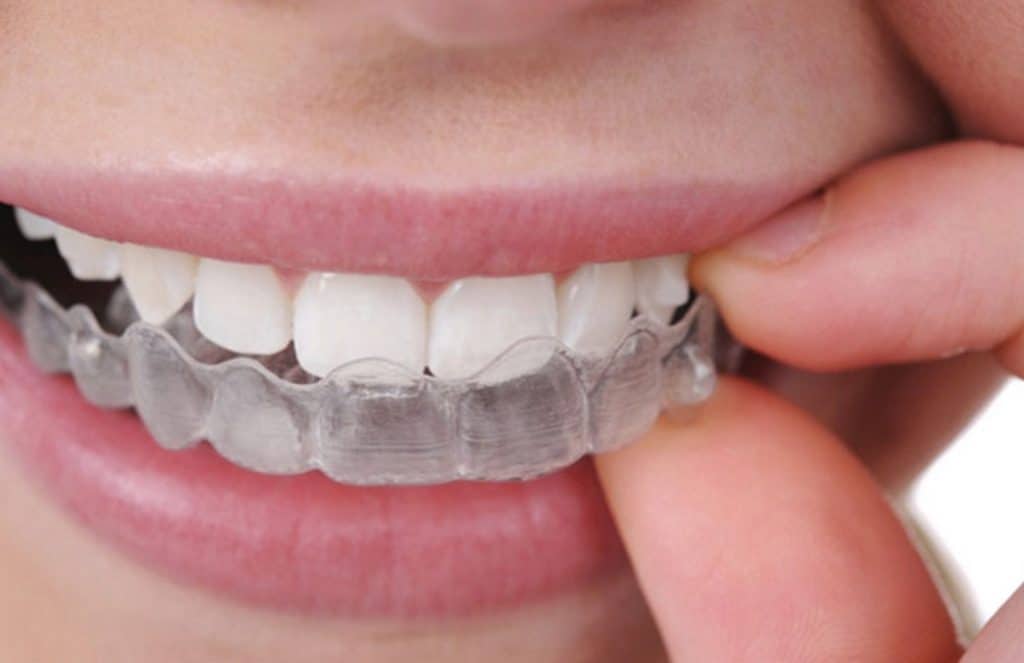 Alineador transparente para valorar ortodoncia invisible cerca de Fuencarral