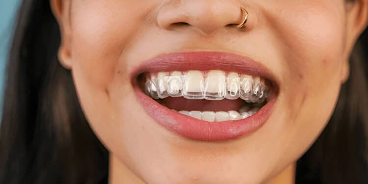 Alineadores invisibles Invisalign sobre modelo dental