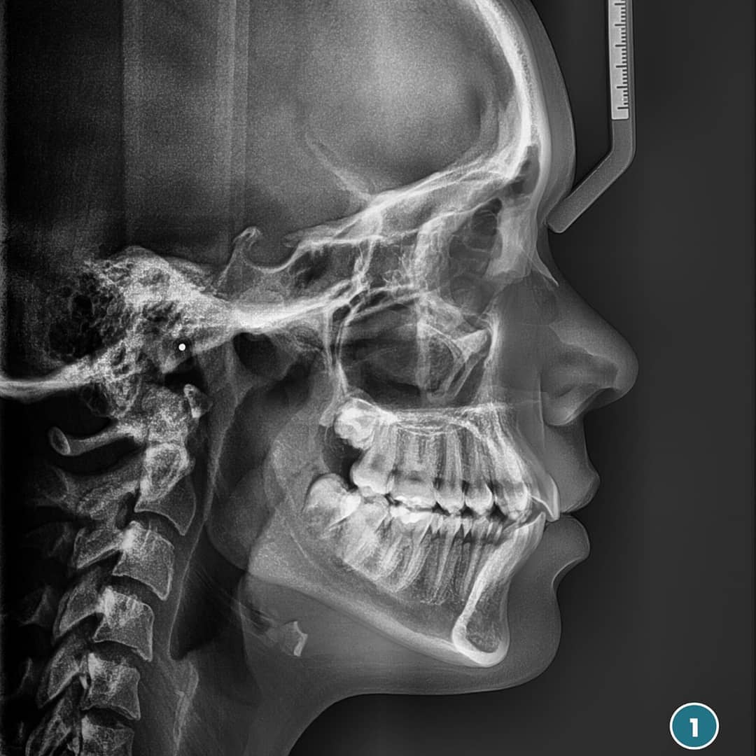 Diagnóstico periodontal y radiográfico antes de planificar implantes dentales