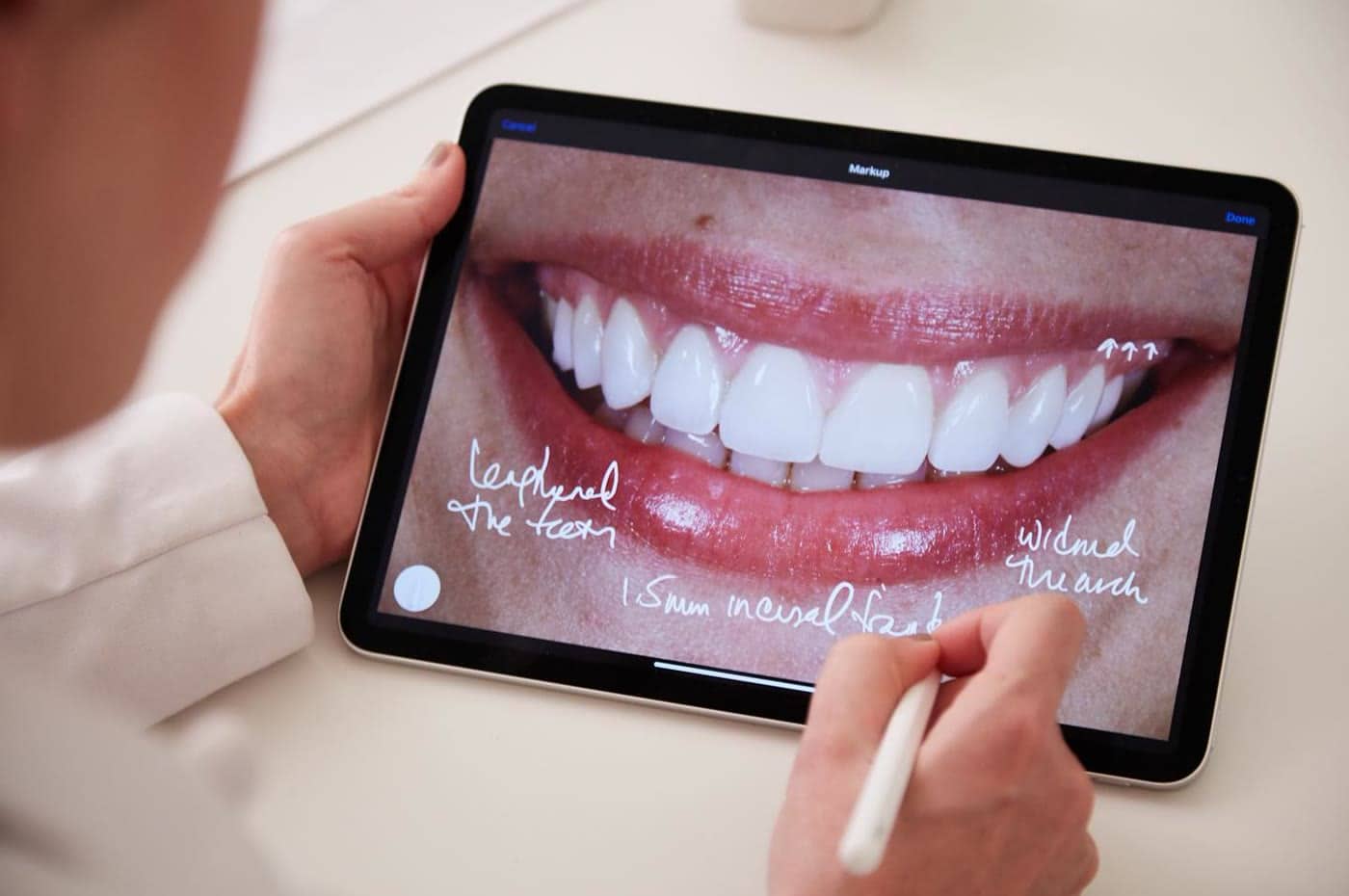 Planificación de diseño de sonrisa antes de valorar carillas dentales en Carabanchel