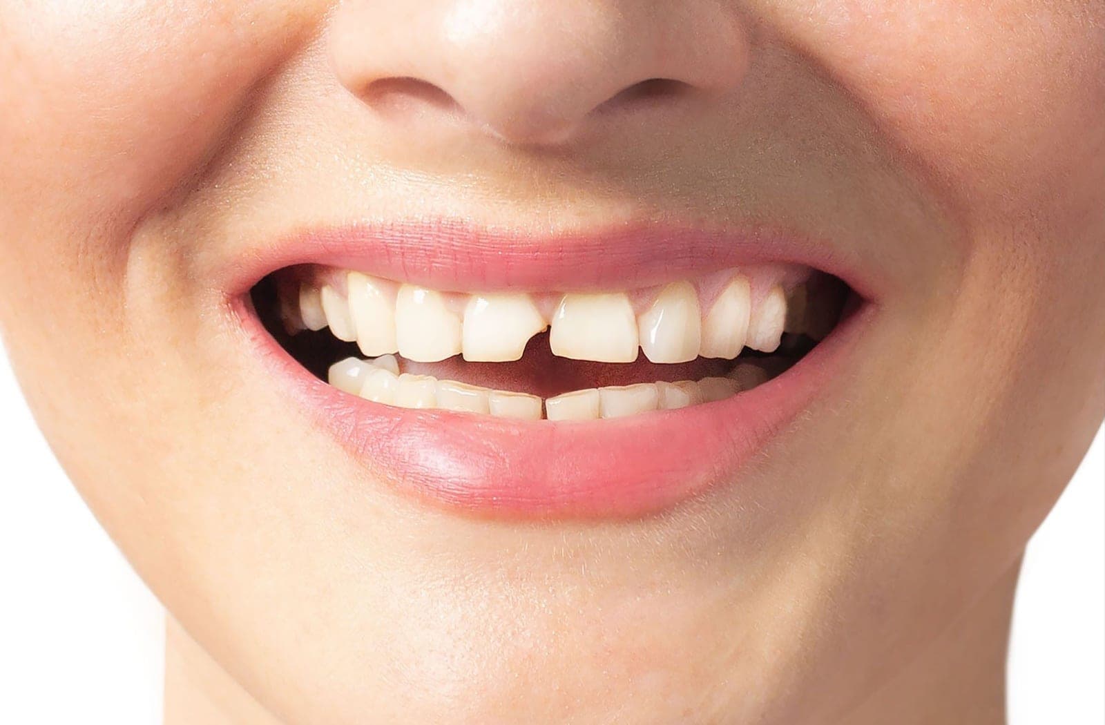 Mordida abierta que requiere valorar si el origen es dental, esquelético o mixto
