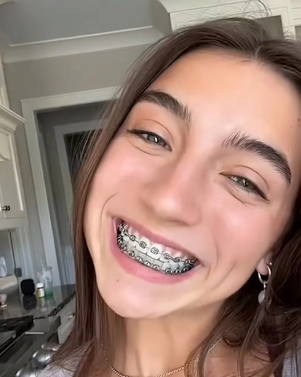 Mujer sonriendo con brackets metálicos