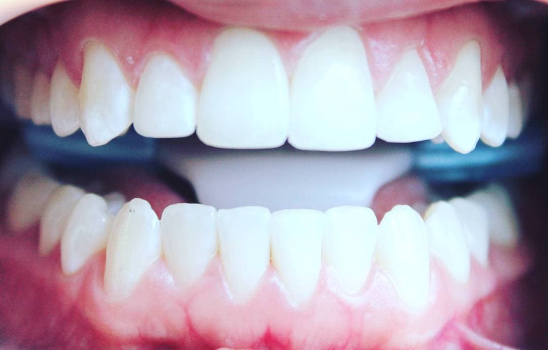 ¿Duele el implante dental? Recuperación en Madrid