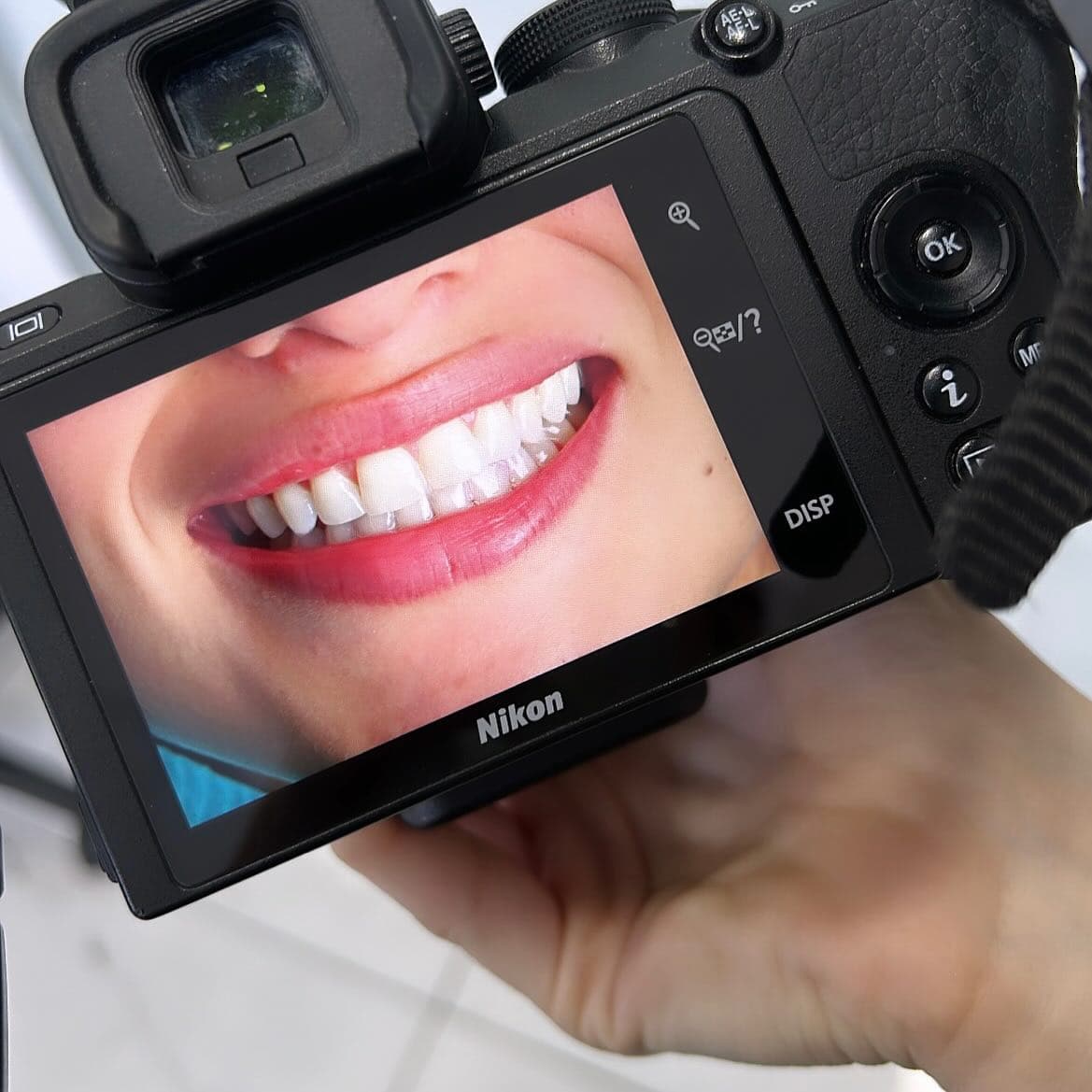 Fotografía dental para valorar desgaste y bruxismo en Madrid