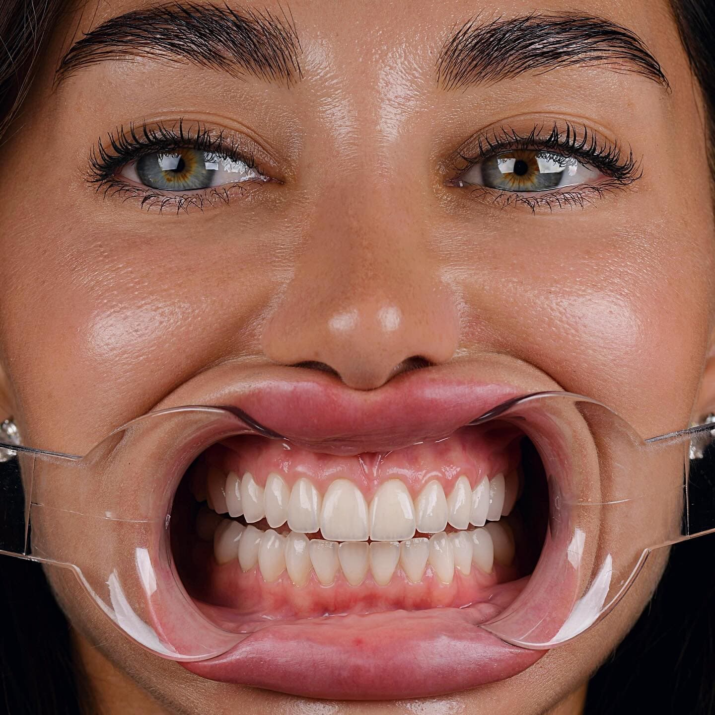 Retractor dental mostrando encía para revisar periodoncia