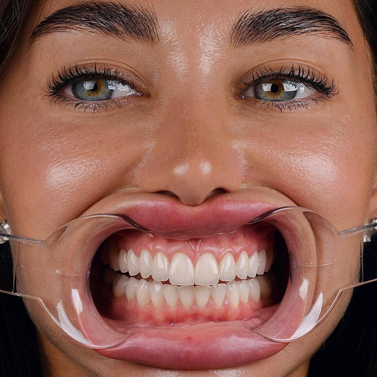 Retractor dental mostrando encía para revisar periodoncia